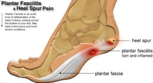 plantarfasciitis-spur