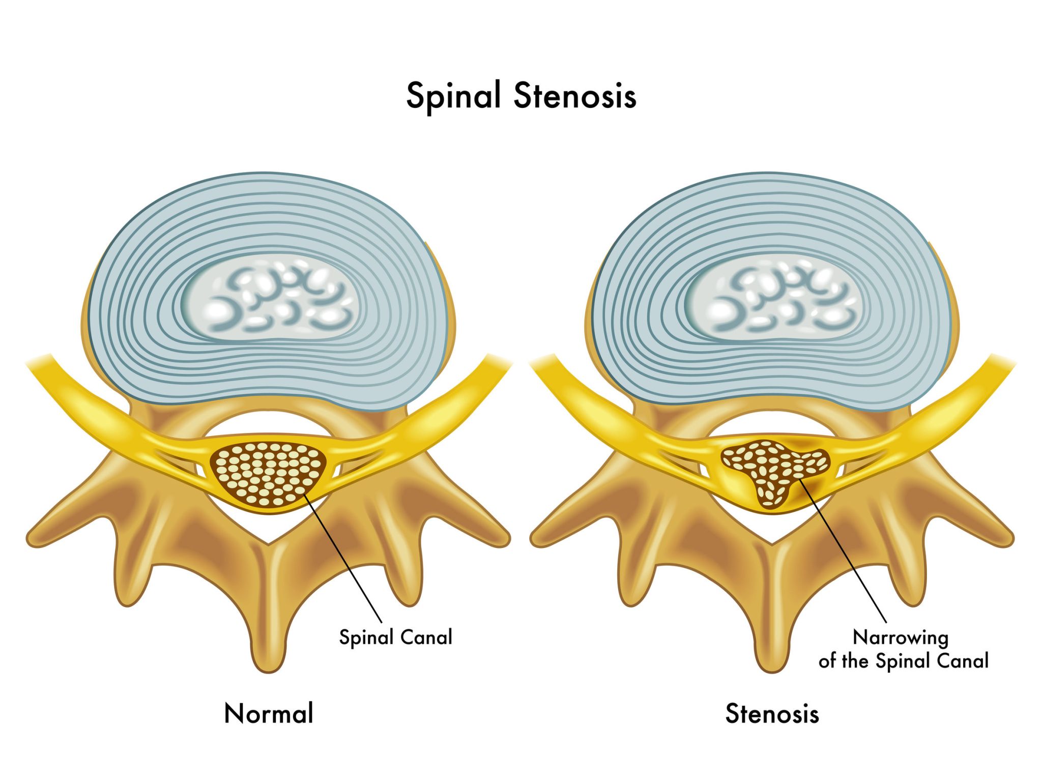 Chiropractor Marine City Treats Spinal Stenosis Chiropractor Marine City MI Treats Spinal Stenosis