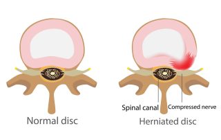 Chiropractor Marine City MI Treats Bulged and Bulging Disc Pinching a Nerve